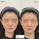 鼻翼基部　ほうれい線ヒアルロン酸 before画像 サムネイル用