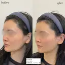 鼻翼基部　ほうれい線ヒアルロン酸 after画像 サムネイル用