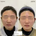 糸リフト　顎ヒアルロン酸 before画像 サムネイル用