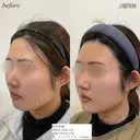 糸リフト　顎ヒアルロン酸 after画像 サムネイル用