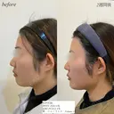 糸リフト　顎ヒアルロン酸 after画像 サムネイル用