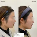 糸リフト　顎ヒアルロン酸 after画像 サムネイル用