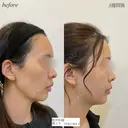 頬コケヒアルロン酸 after画像 サムネイル用