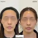 頬コケヒアルロン酸 before画像 サムネイル用