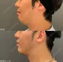 複合治療でフェイスライン形成🌴脂肪吸引（頬・顎下）+ヒアルロン酸注入（顎）+ボツラックス（顎）注入✨ after画像 サムネイル用