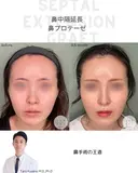 鼻中隔延長&鼻プロテーゼ before画像 サムネイル用