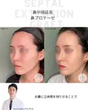 鼻中隔延長&鼻プロテーゼ 105日後 サムネイル用