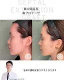 鼻中隔延長&鼻プロテーゼ 105日後 サムネイル用