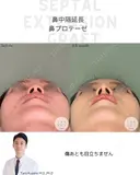 鼻中隔延長&鼻プロテーゼ 105日後 サムネイル用