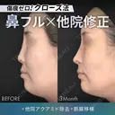 他院アクアミド除去＋鼻フルコース［クローズ法］（鼻複合自家組織移植術）＋筋膜移植 before画像 サムネイル用