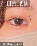 目頭切開 7日後 サムネイル用
