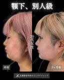 顎下脂肪吸引で別人級？！ after画像 サムネイル用