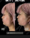 顎下脂肪吸引で別人級？！ before画像 サムネイル用