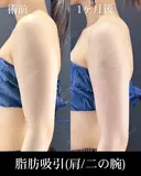 脂肪吸引(肩/二の腕) before画像 サムネイル用