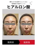 ヒアルロン酸注入 before画像 サムネイル用