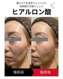 ヒアルロン酸注入 0日後 サムネイル用