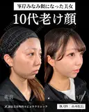 山本医師による🎀小顔脂肪吸引🎀 before画像 サムネイル用