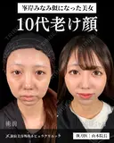 山本医師による🎀小顔脂肪吸引🎀 after画像 サムネイル用