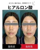 ヒアルロン酸注入 0日後 サムネイル用