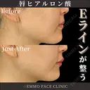 ヒアルロン酸（唇） before画像 サムネイル用