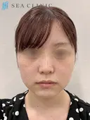 SEAライン3D脂肪吸引(頬・顎下)/エラボトックス before画像 サムネイル用