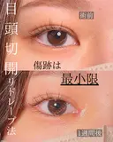 目頭切開 after画像 サムネイル用