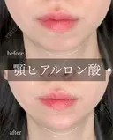 顎　ヒアルロン酸 after画像 サムネイル用