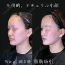 Wing小顔女神脂肪吸引 30日後 サムネイル用