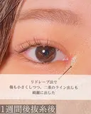目頭切開 after画像 サムネイル用