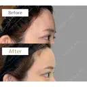 おでこヒアルロン酸 before画像 サムネイル用