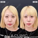 【Aスレッド(繊維)】Aスレッドでもたつきをグイっと引き上げて超シャープなフェイスラインに！こちら処置前と直後の症例です after画像 サムネイル用