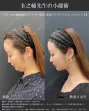 アキーセル脂肪吸引ベイザー併用(頬顎下ジョールファット)＋糸リフト before画像 サムネイル用