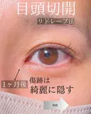 目頭切開 after画像 サムネイル用