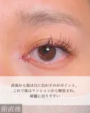 目頭切開 after画像 サムネイル用