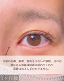 目頭切開 after画像 サムネイル用