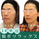 患者様ごとに微調整💉ボツラックス（額）10単位注入✨おでこのシワ改善や予防/形成外科専門医がご対応 before画像 サムネイル用