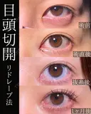 目頭切開 after画像 サムネイル用