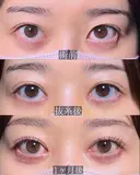 目頭切開 after画像 サムネイル用