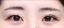 【20代女性・MIX二重で目元をぱっちり】二重術（埋没法）：マイクロメソッド+α（術後2ヶ月） before画像 サムネイル用