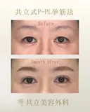 共立式二重埋没P-PL挙筋法 30日後 サムネイル用