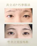 共立式二重埋没P-PL挙筋法 before画像 サムネイル用