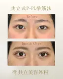 共立式二重埋没P-PL挙筋法 before画像 サムネイル用