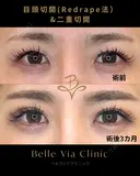 目頭切開+二重切開 after画像 サムネイル用