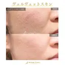 ヴェルヴェットスキン before画像 サムネイル用