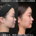 術後2年、軟骨も脂肪も後戻りなし！貴族猫肋軟骨による延長と脂肪注入の長期経過 730日後 サムネイル用