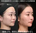術後2年、軟骨も脂肪も後戻りなし！貴族猫肋軟骨による延長と脂肪注入の長期経過 730日後 サムネイル用