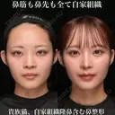 鼻筋も鼻先も全て自家組織/貴族猫、自家組織隆鼻含む鼻整形 90日後 サムネイル用