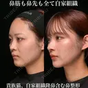鼻筋も鼻先も全て自家組織/貴族猫、自家組織隆鼻含む鼻整形 90日後 サムネイル用
