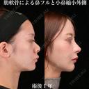 肋軟骨による鼻フルと小鼻縮小外側 365日後 サムネイル用