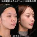 肋軟骨による鼻フルと小鼻縮小外側 365日後 サムネイル用